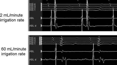 electrophysiology arrhythmia near belmont|Signals and Signal Processing for the Electrophysiologist.